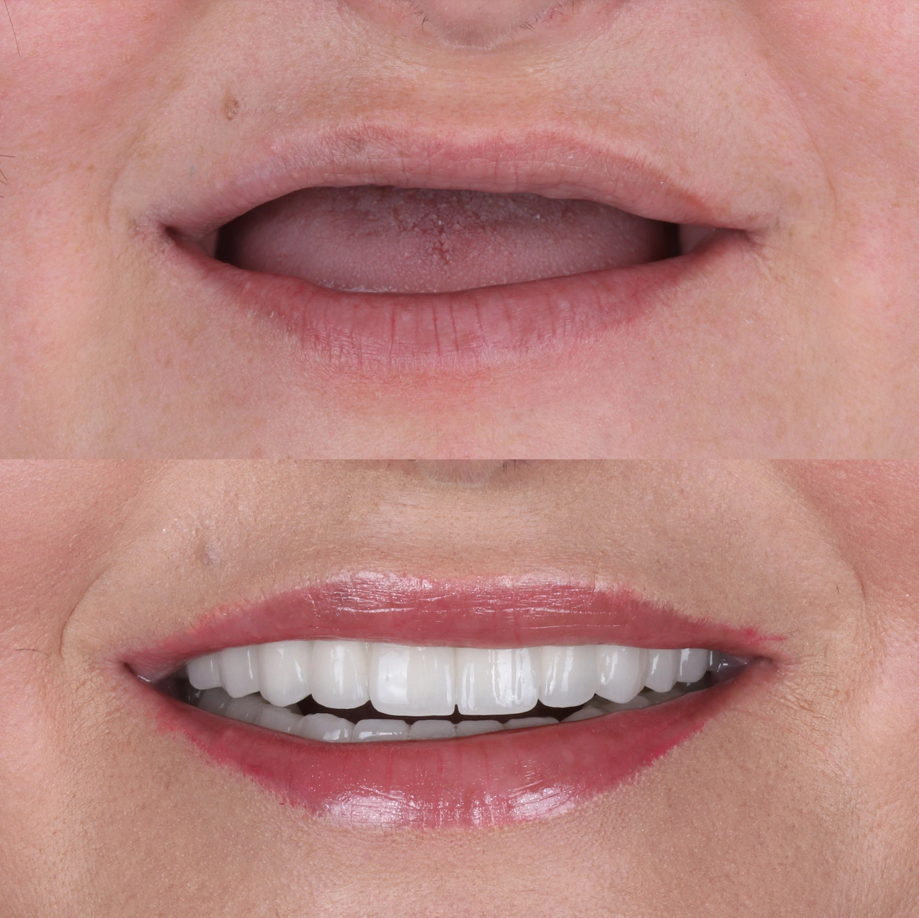 EQ Smile - Zahnarztpraxis - Zahnimplantate auf Knochenniveau und Vollbogen-Zahnprothesen in der Zahnmedizin.