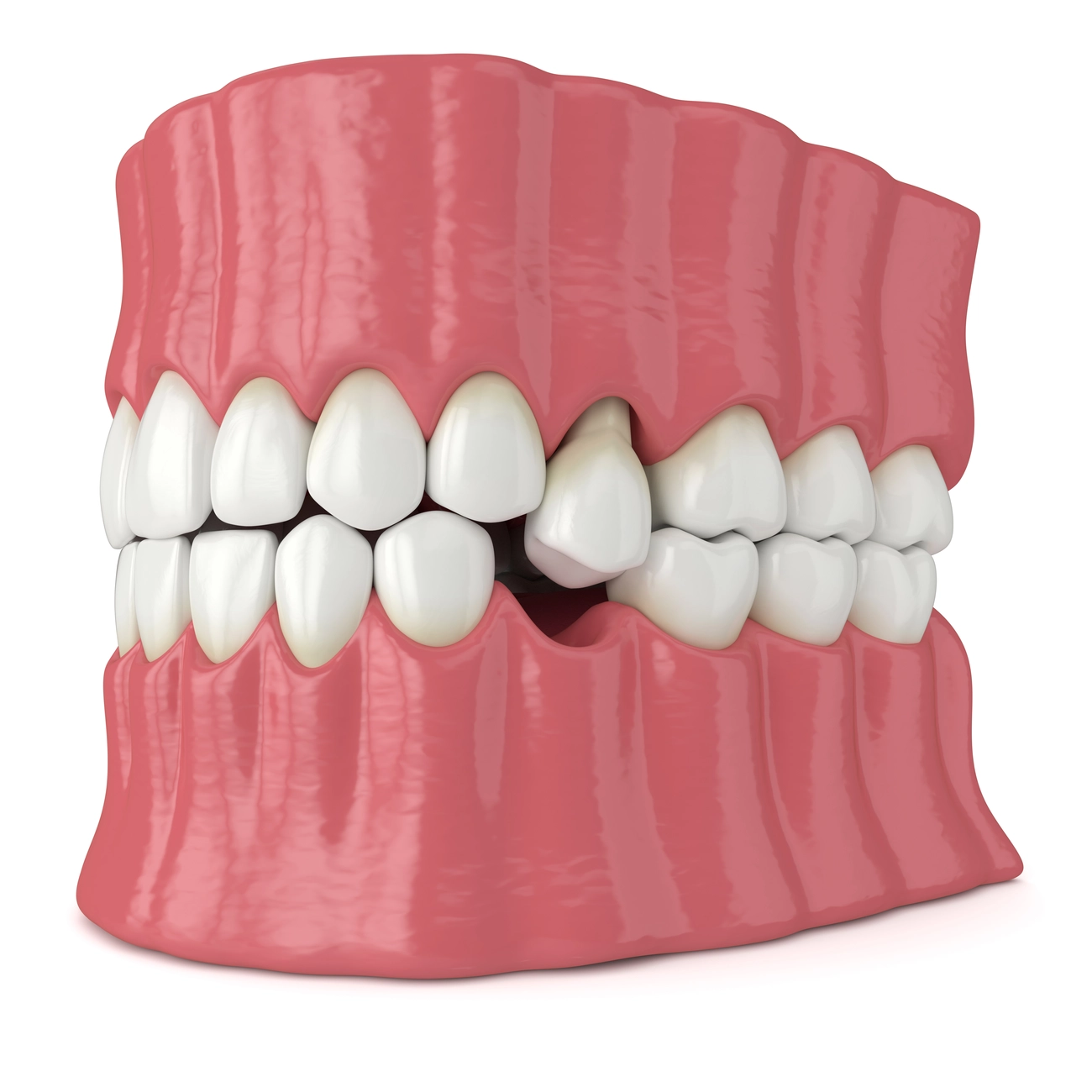EQ Smile - Zahnarztpraxis - 3D-Darstellung eines Kiefers mit hervorstehendem Zahn, der die Wurzel freigibt