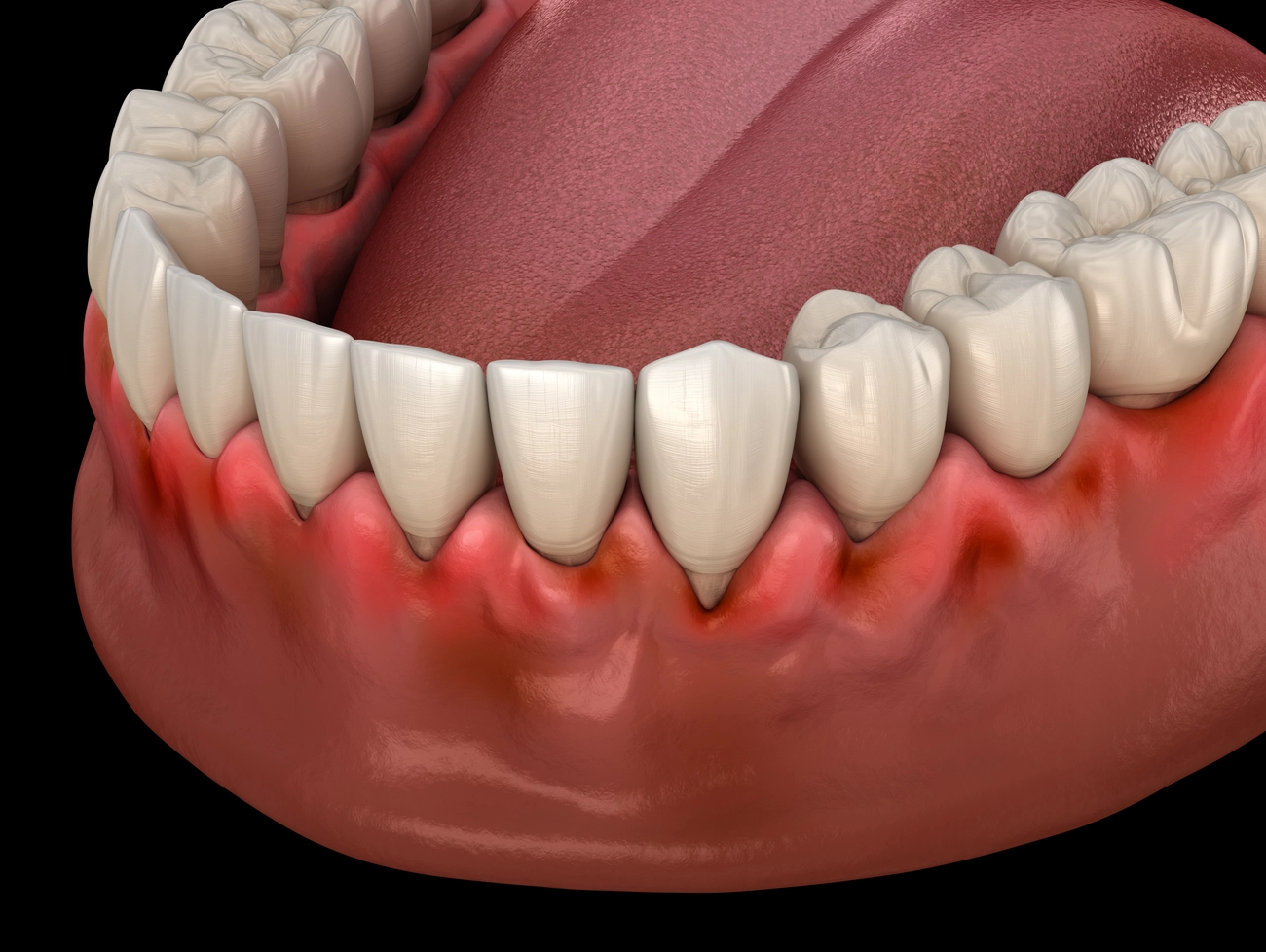 EQ Smile - Zahnarztpraxis - Gingivitis, Entzündung des Zahnfleisches. Dentale 3D-Illustration