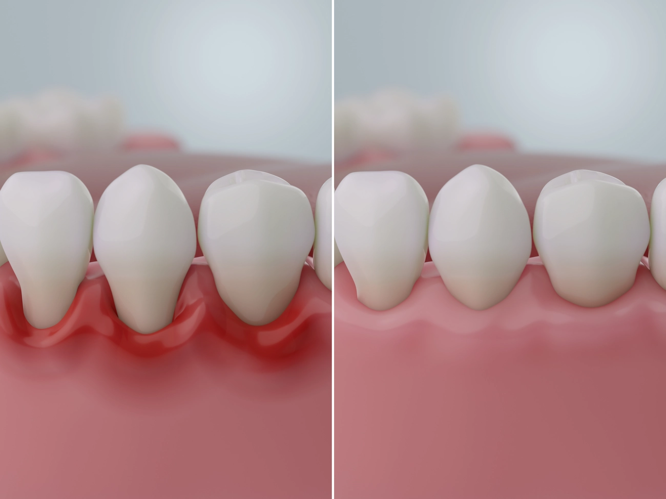 EQ Smile - Zahnarztpraxis - Zahnfleischerkrankungen vorher und nachher, Gingivitis vs. gesundes Zahnfleisch.