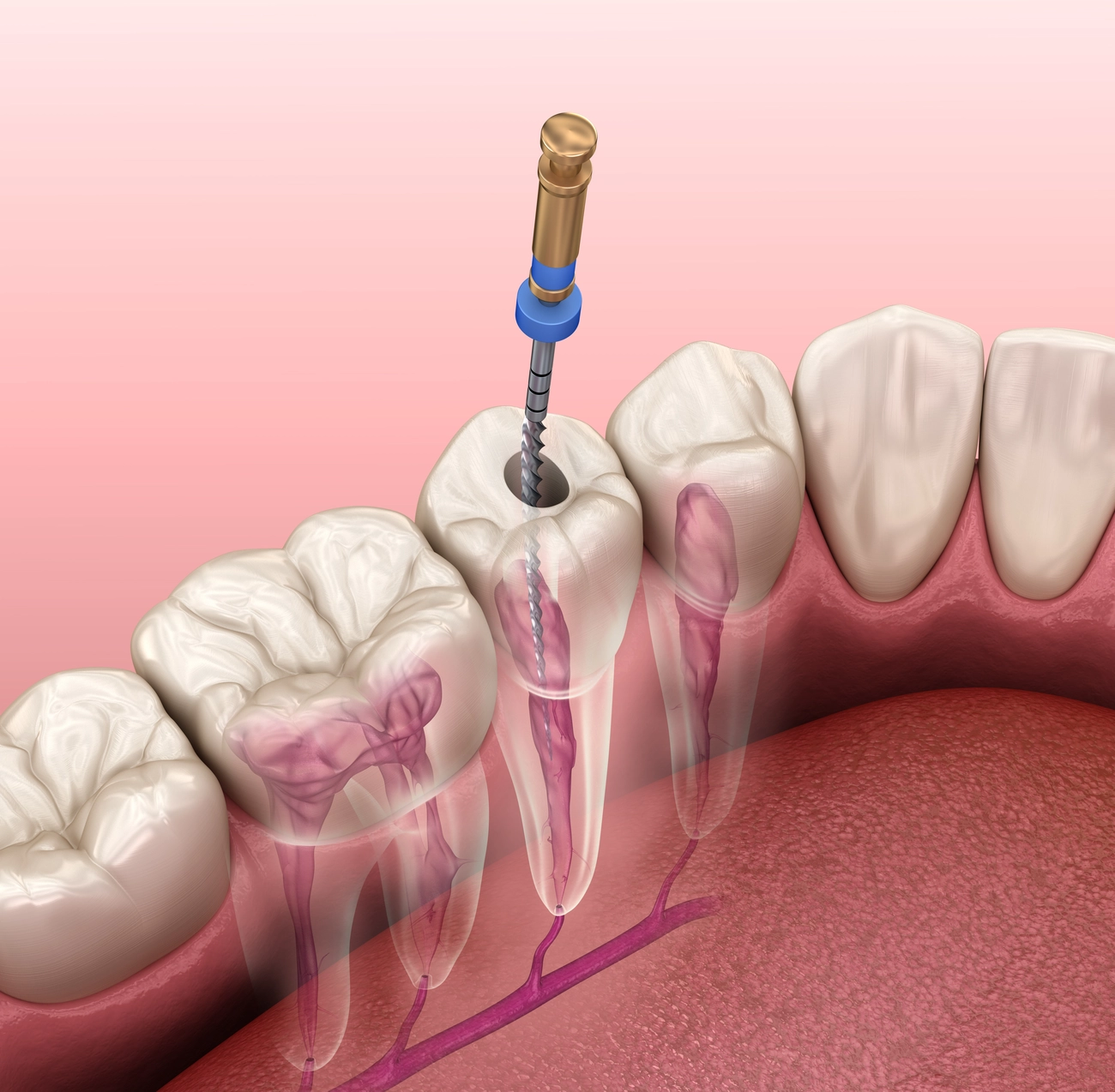EQ Smile - Zahnarztpraxis - Endodontischer Wurzelkanalbehandlungsprozess. Medizinisch genaue 3D-Illustration des Zahns.