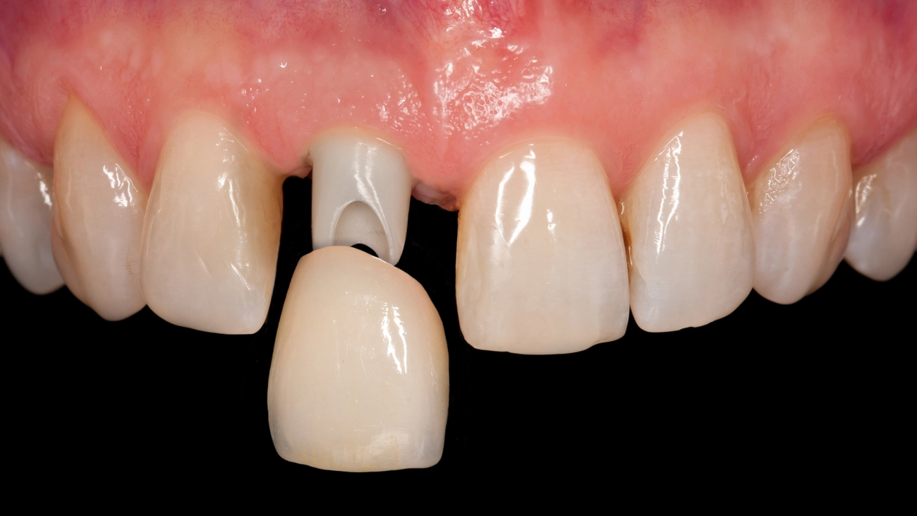 EQ Smile - Zahnarztpraxis - Krone auf Implantat 