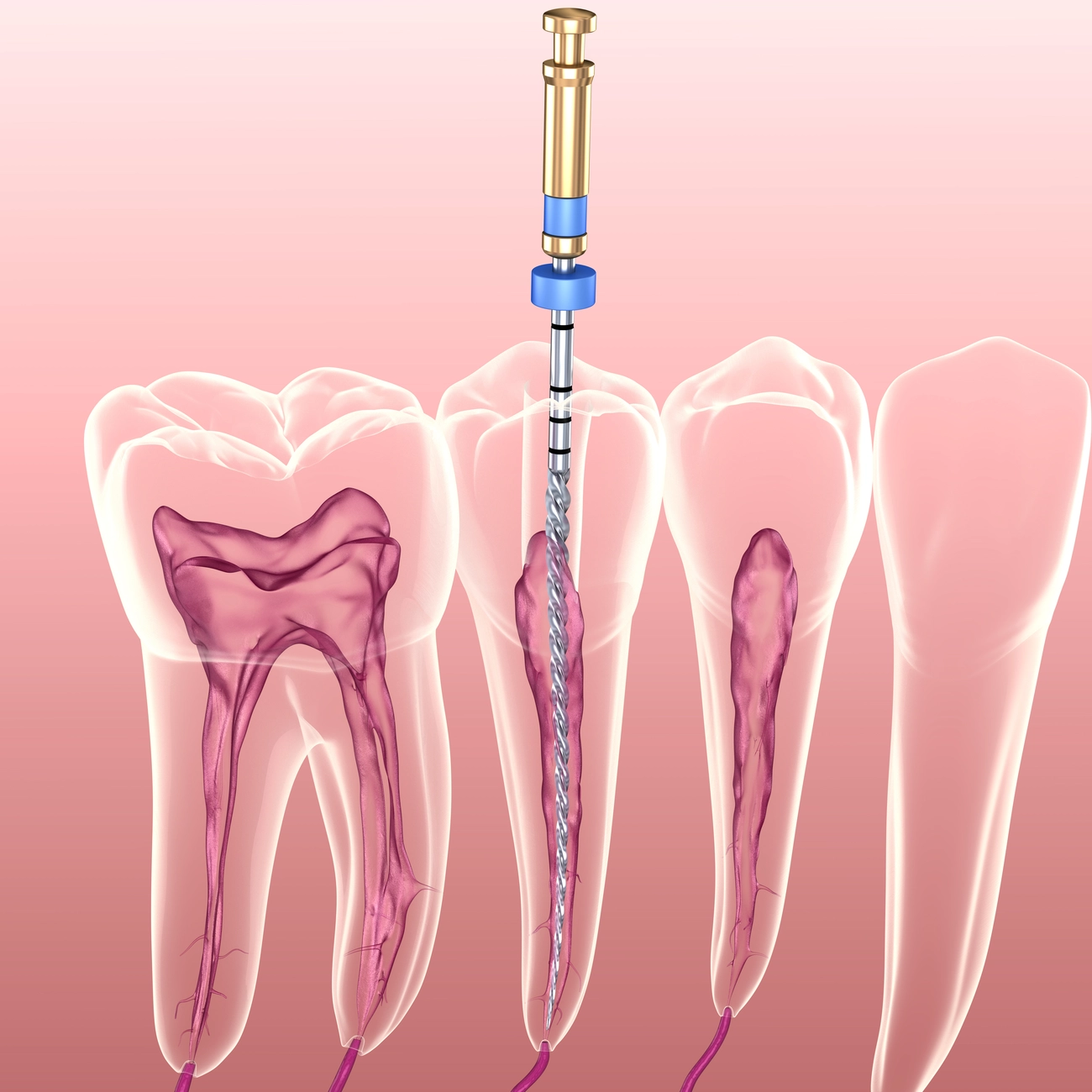 EQ Smile - Zahnarztpraxis - Ablauf einer endodontischen Wurzelkanalbehandlung