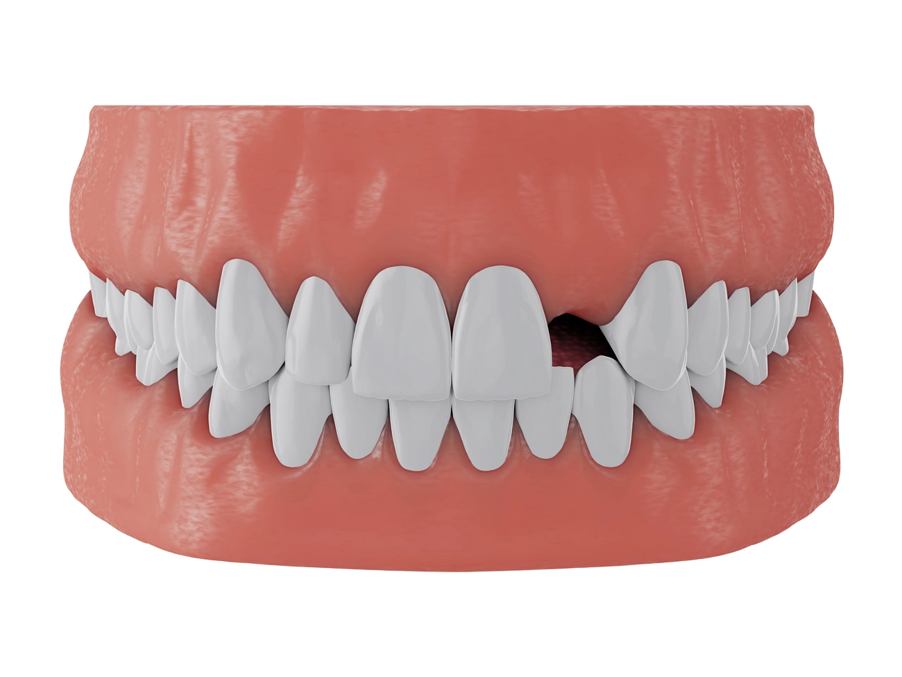 EQ Smile - Zahnarztpraxis - Kiefer mit fehlenden Vorderzahn Zwei auf weißem Hintergrund, 3D-Rendering