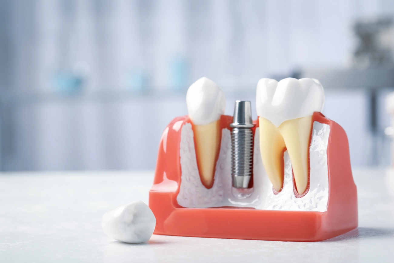 EQ Smile - Zahnarztpraxis - Lehrmodell mit Pfosten und Abutment eines Zahnimplantats zwischen den Zähnen auf einem weißen Tisch im Innenbereich.